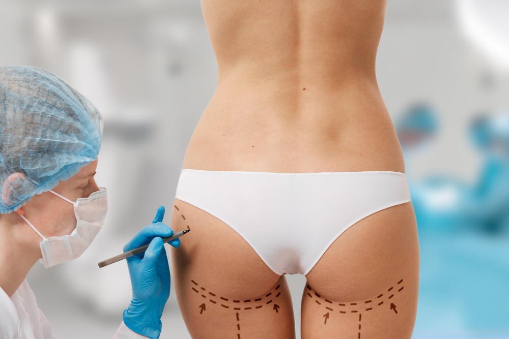Liposukcija - više od uklanjanja masnih naslaga