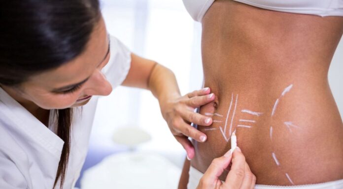 Abdominoplastika – kada ravan stomak postane realna i trajna opcija Abdominoplastika – kada ravan stomak postane realna i trajna opcija